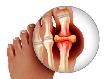 What Is The Main Cause Of Gout?